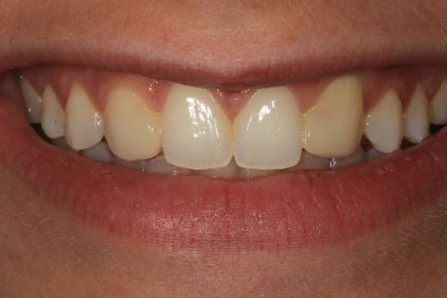 Porcelain Veneers: Stephanie - Before