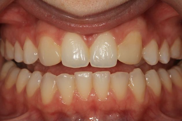 Porcelain Veneers: Stephanie - Before