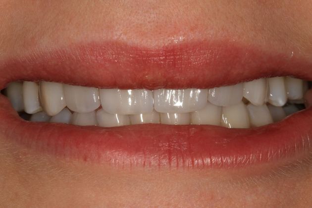 Porcelain Veneers: Stephanie - After