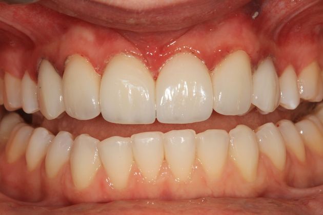 Porcelain Veneers: Stephanie - After