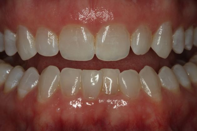 Laser Gum Reshaping Case 2 - Before