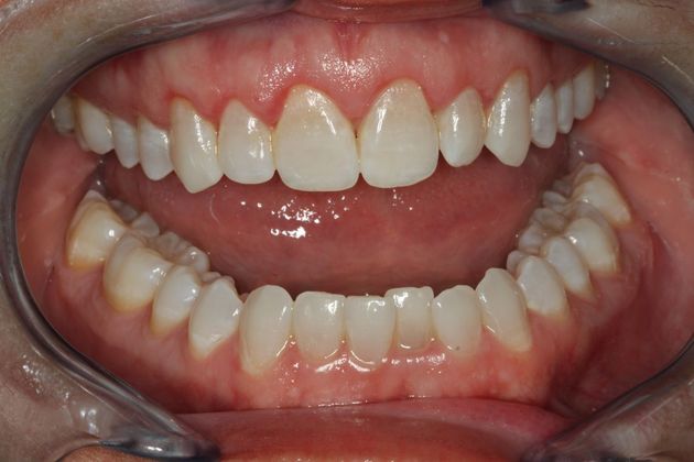Laser Gum Reshaping Case 2 - After