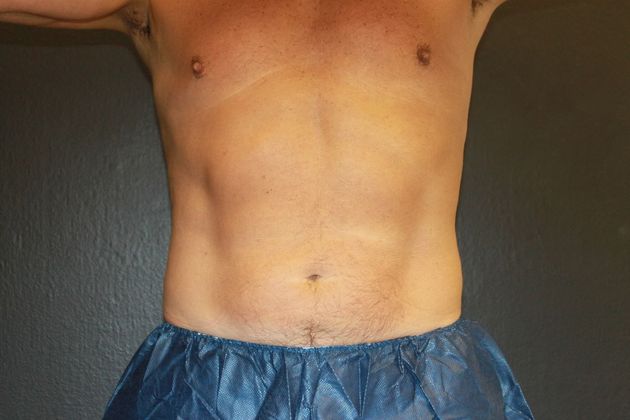 CoolSculpting®: Case 6 - After (3 SESSIONS/2 APPLICATORS)