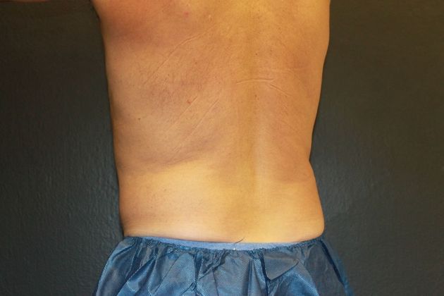 CoolSculpting®: Case 7 - After (3 SESSIONS/2 APPLICATORS)