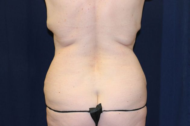 Liposuction & Safe Lipo: Case 24 - Before