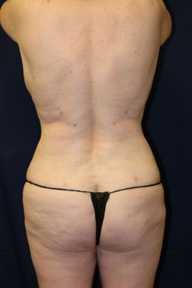 Liposuction & Safe Lipo: Case 24 - After