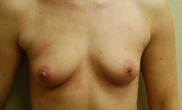 Breast Augmentation Case 524 - Before