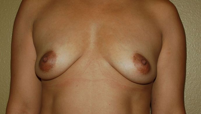 Breast Augmentation Case 525 - Before