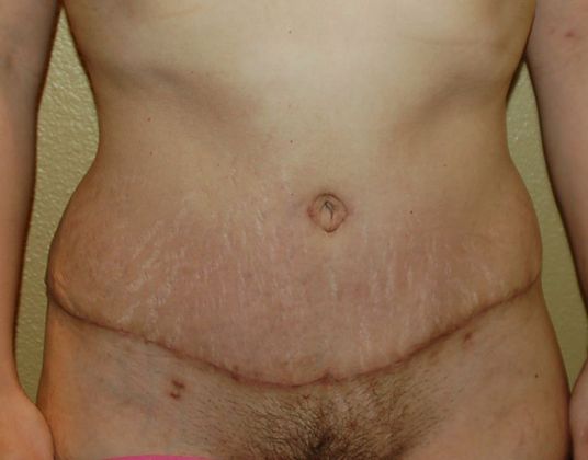 Tummy Tuck (Abdominoplasty) Case 159 - After