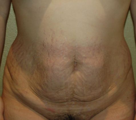 Tummy Tuck (Abdominoplasty) Case 159 - Before