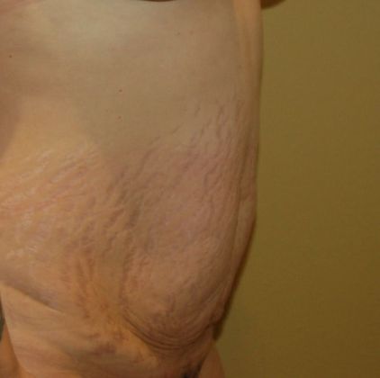 Tummy Tuck (Abdominoplasty): Case 159 - Before