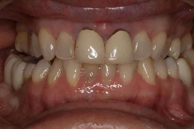 Porcelain Veneers Porcelain veneers for aesthetics - Before