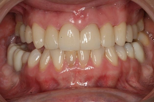 Porcelain Veneers Porcelain veneers for aesthetics - After