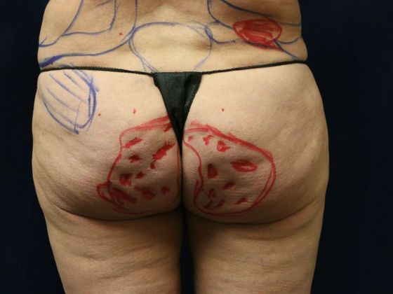 Liposuction & Safe Lipo Case 27 - Before