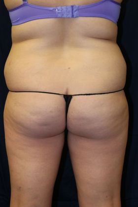 Liposuction & Safe Lipo: Case 28 - Before