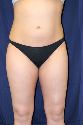 Liposuction & Safe Lipo: Case 26 - After