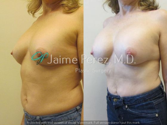 Breast Augmentation: 63-year-old female: Breast Augmentation with Silicone Implants - Before & After