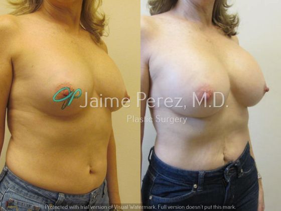 Breast Augmentation: 63-year-old female: Breast Augmentation with Silicone Implants - Before & After
