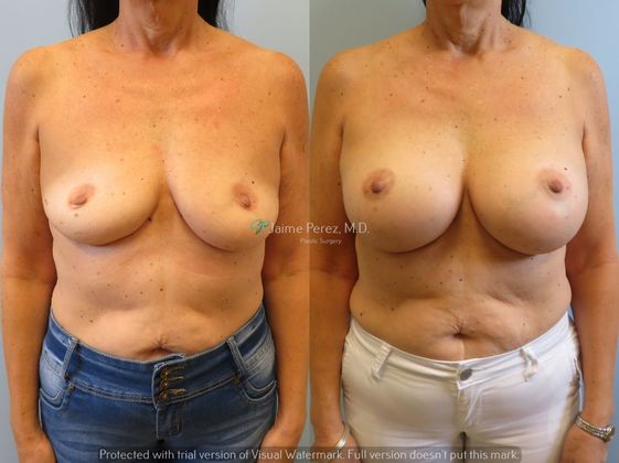 Breast Augmentation: 59-year-old female: Breast Augmentation with 550cc Silicone Implants - Before & After