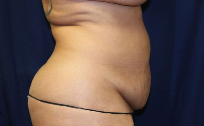 Liposuction & Safe Lipo: Case 20 - Before
