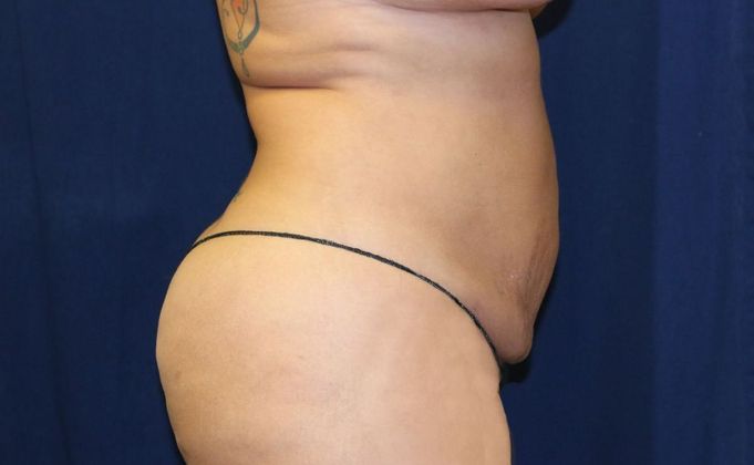 Liposuction & Safe Lipo: Case 20 - After
