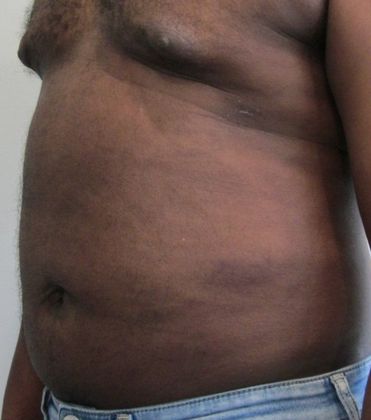 Liposuction: Case 12- Stamford Liposuction - After