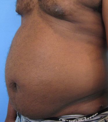 Liposuction: Case 12- Stamford Liposuction - Before