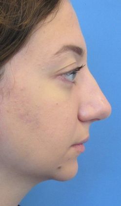 Rhinoplasty: Case 8 - Rhinoplasty Fairfield - After