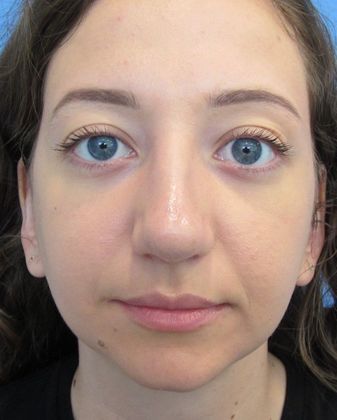 Rhinoplasty: Case 8 - Rhinoplasty Fairfield - After