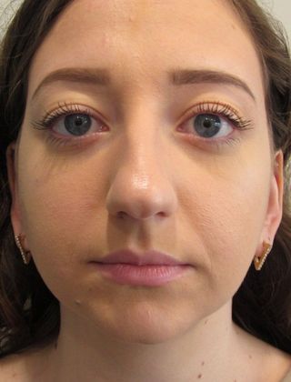 Rhinoplasty: Case 8 - Rhinoplasty Fairfield - Before