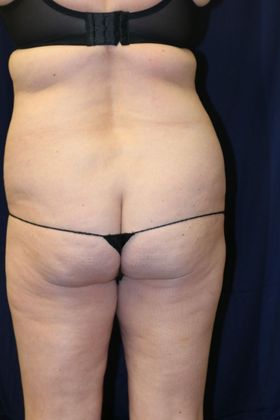 Liposuction & Safe Lipo: Case 31 - Before