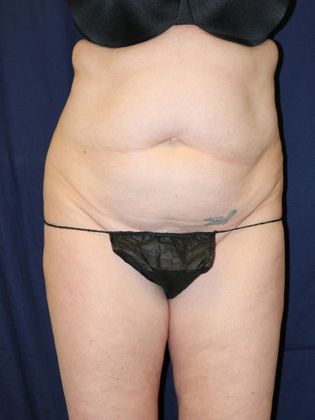 Liposuction & Safe Lipo: Case 31 - Before