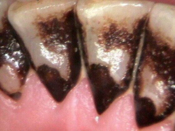 Dental Hygiene: Case 1 - Before