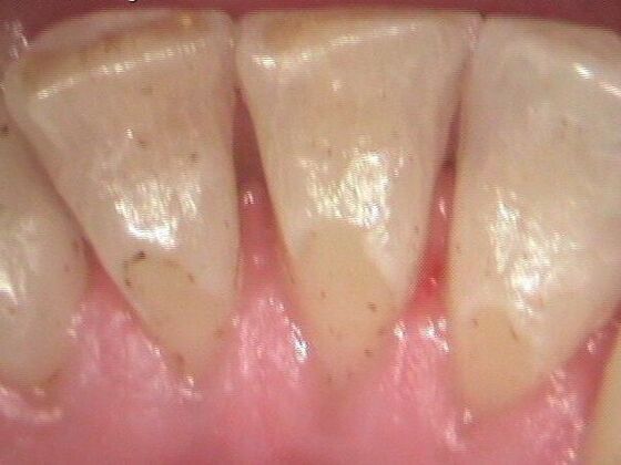 Dental Hygiene: Case 1 - After