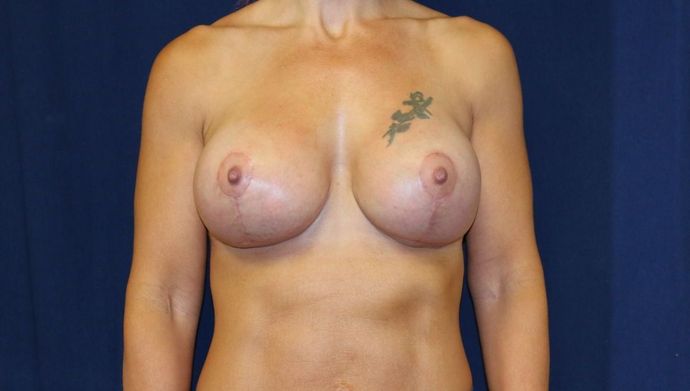 Breast Lift With Augmentation* Case 25 - After