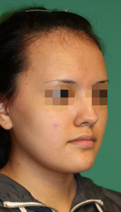 Hairline Lowering Surgery: Case 6 - Before