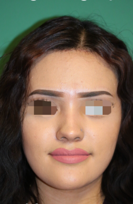 Hairline Lowering Surgery Case 6 - After