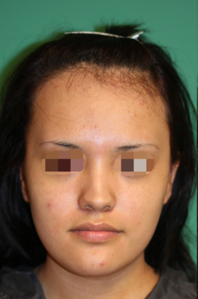 Hairline Lowering Surgery Case 6 - Before