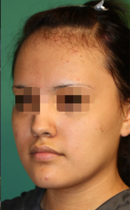 Hairline Lowering Surgery: Case 6 - Before