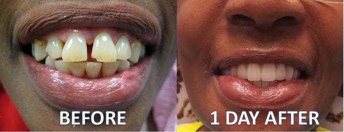 Full Mouth Reconstruction Case 1