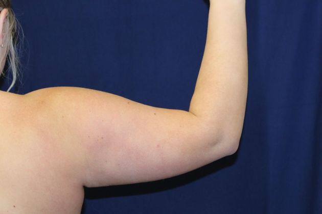 Arm Lift*/Arm Sculpting: Case 9 - Before