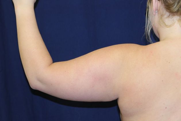 Arm Lift*/Arm Sculpting: Case 9 - Before