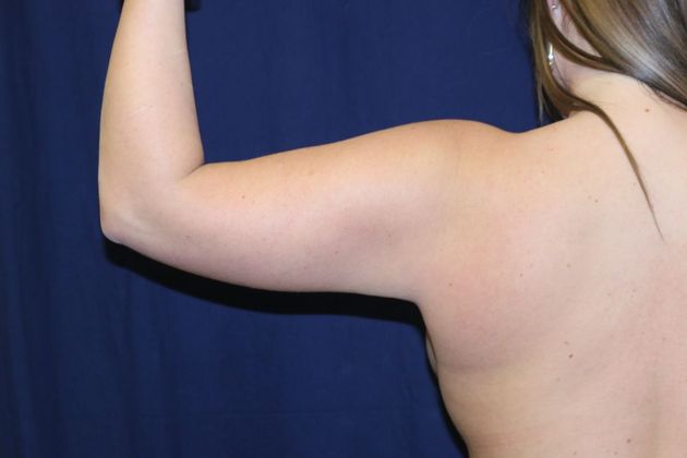 Arm Lift*/Arm Sculpting: Case 9 - After