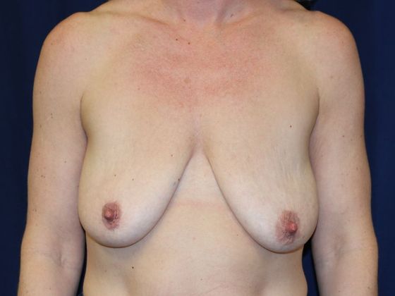 Breast Lift*: Case 3 - Before