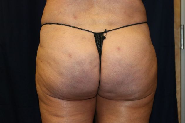 Liposuction & Safe Lipo: Case 27 - After
