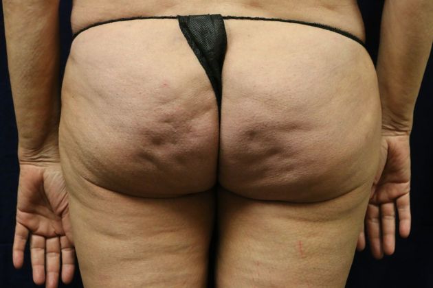 Liposuction & Safe Lipo: Case 27 - Before