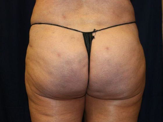 Liposuction & Safe Lipo Case 27 - After