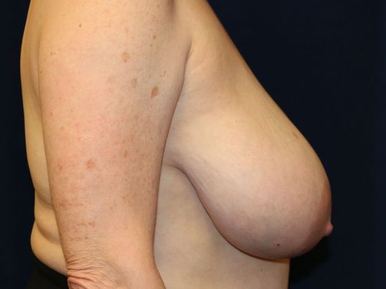 Breast Reduction*: Case 2 - Before