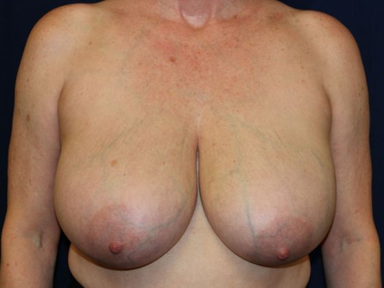 Breast Reduction*: Case 2 - Before