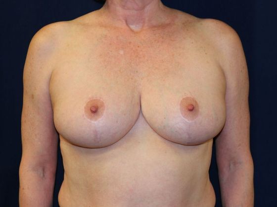 Breast Reduction*: Case 2 - After